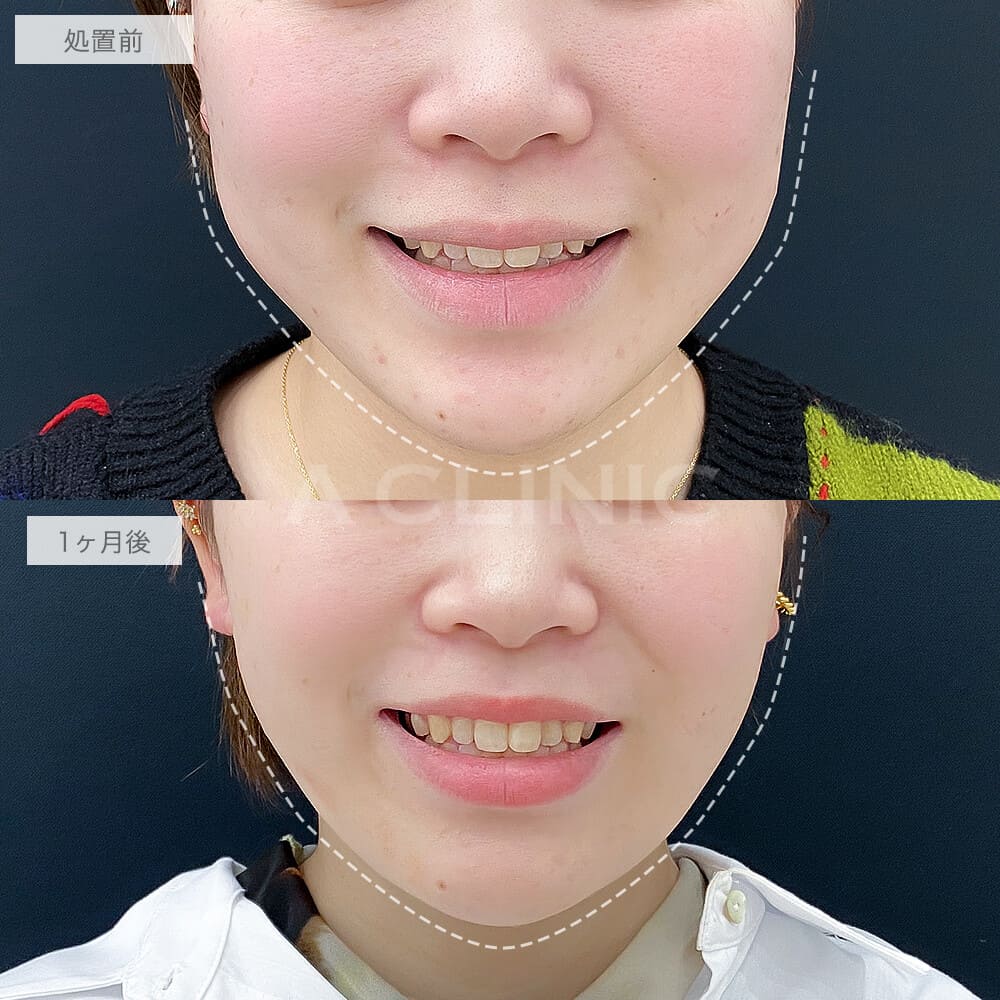 バッカルファット除去術症例写真