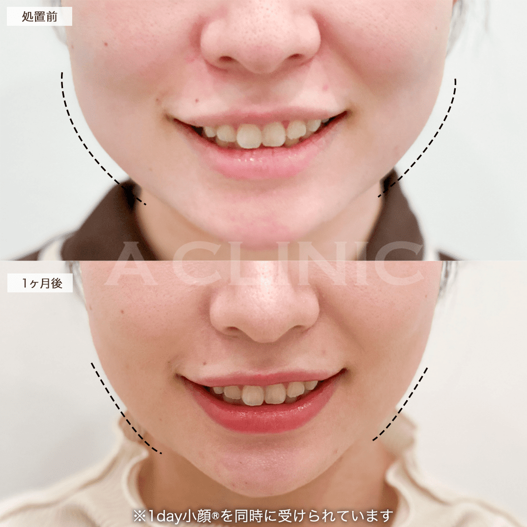 バッカルファット除去術症例写真