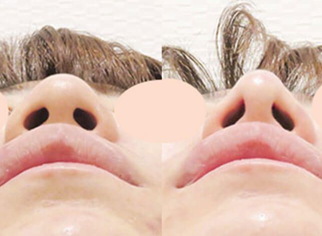 鼻先縮小術 術前と術後