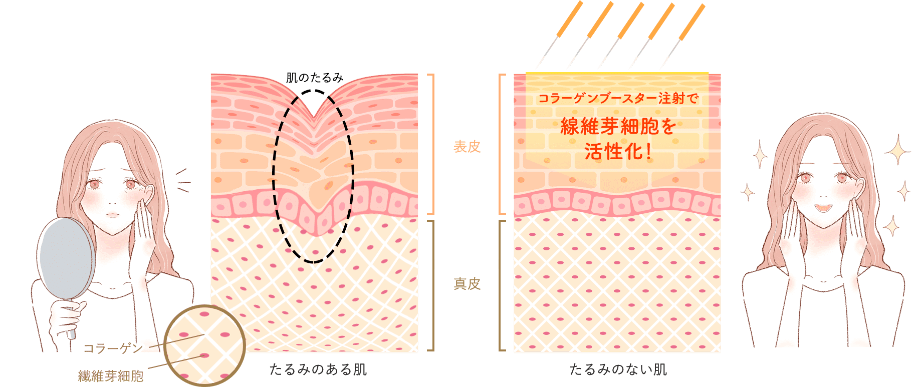 たるみのない肌、コラーゲンブースター注射で線維芽細胞を活性化