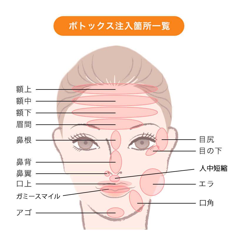 ボトックス注入箇所一覧
