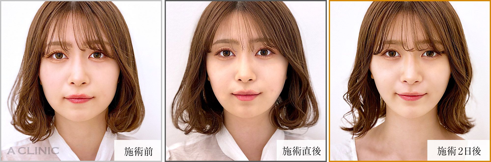 1day小顔脂肪吸引症例
