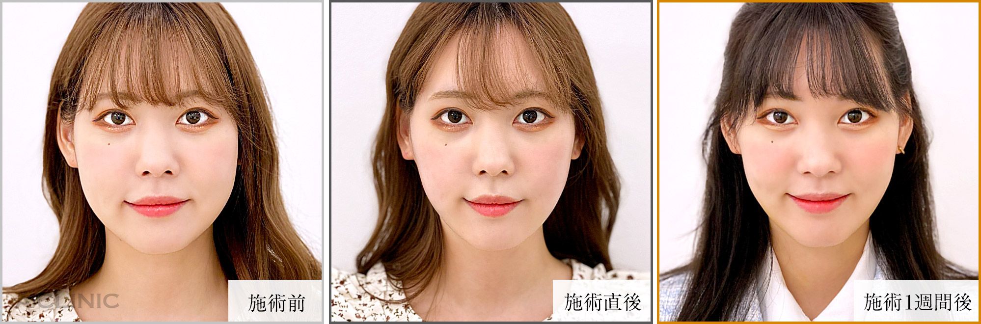 1day小顔脂肪吸引症例