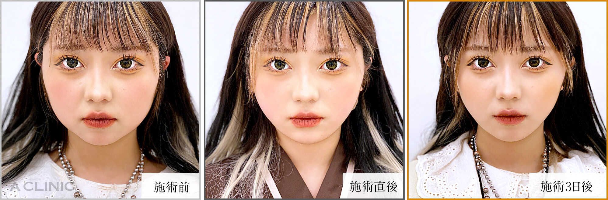 1day小顔脂肪吸引症例