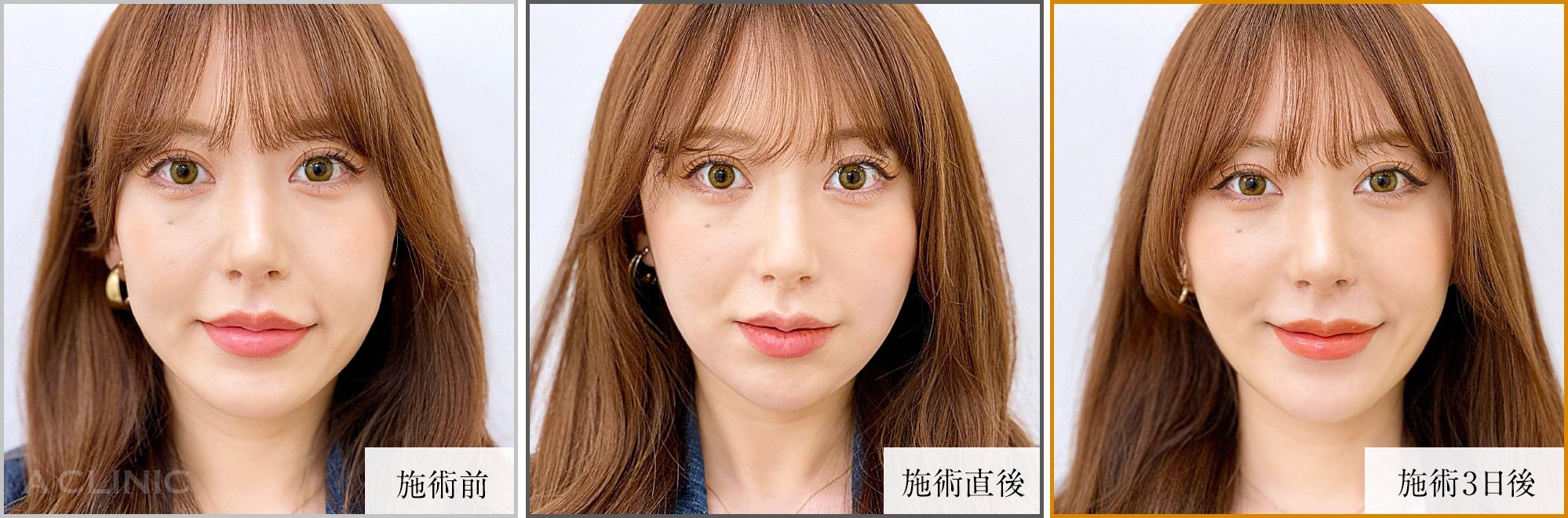 1day小顔脂肪吸引症例