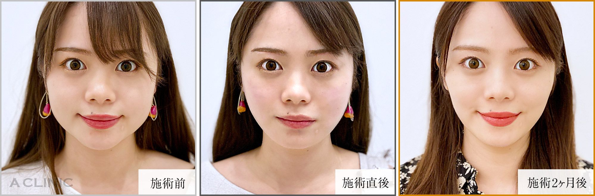 1day小顔脂肪吸引症例
