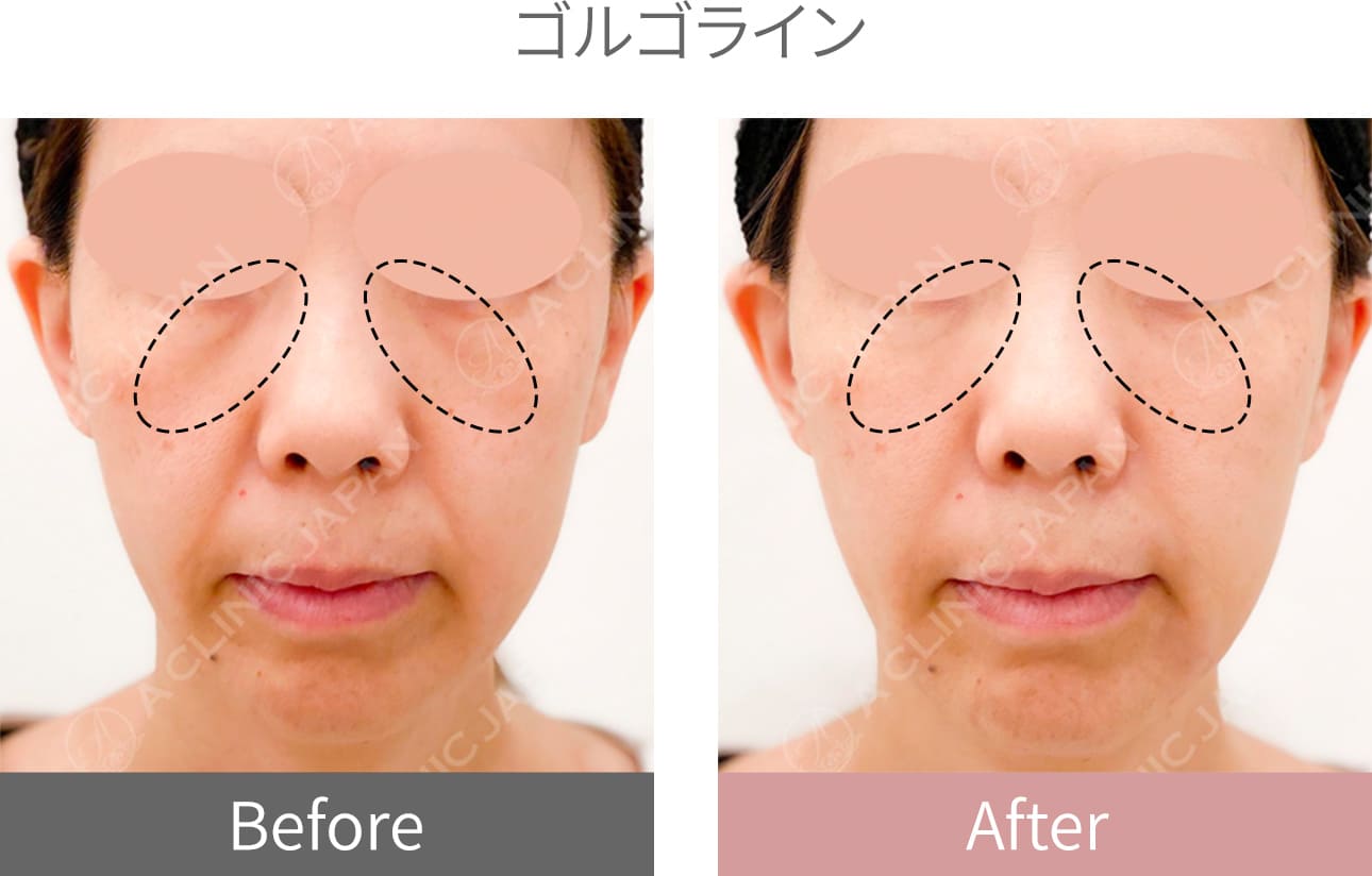 ヒアルロン酸症例写真3