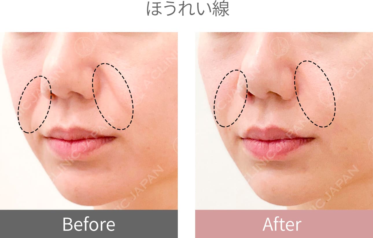ヒアルロン酸症例写真4