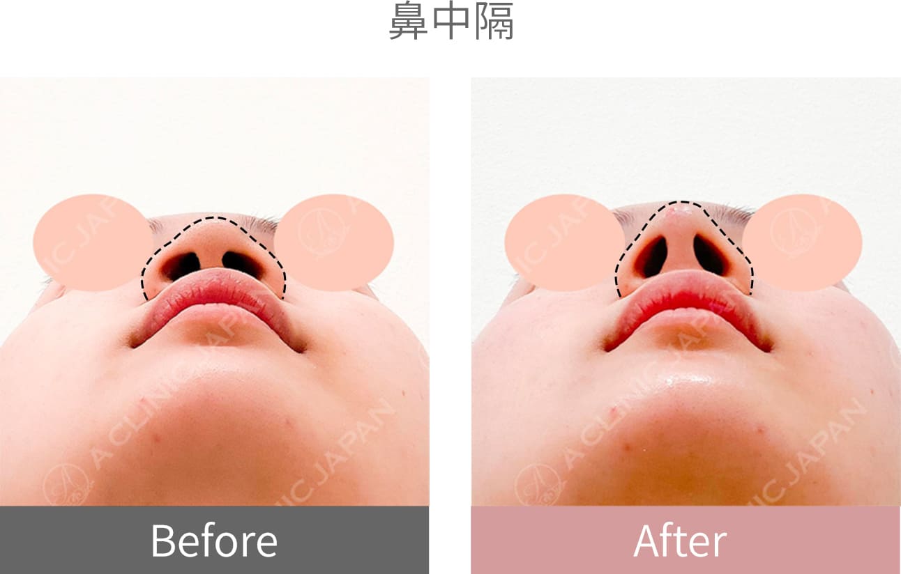 ヒアルロン酸症例写真6