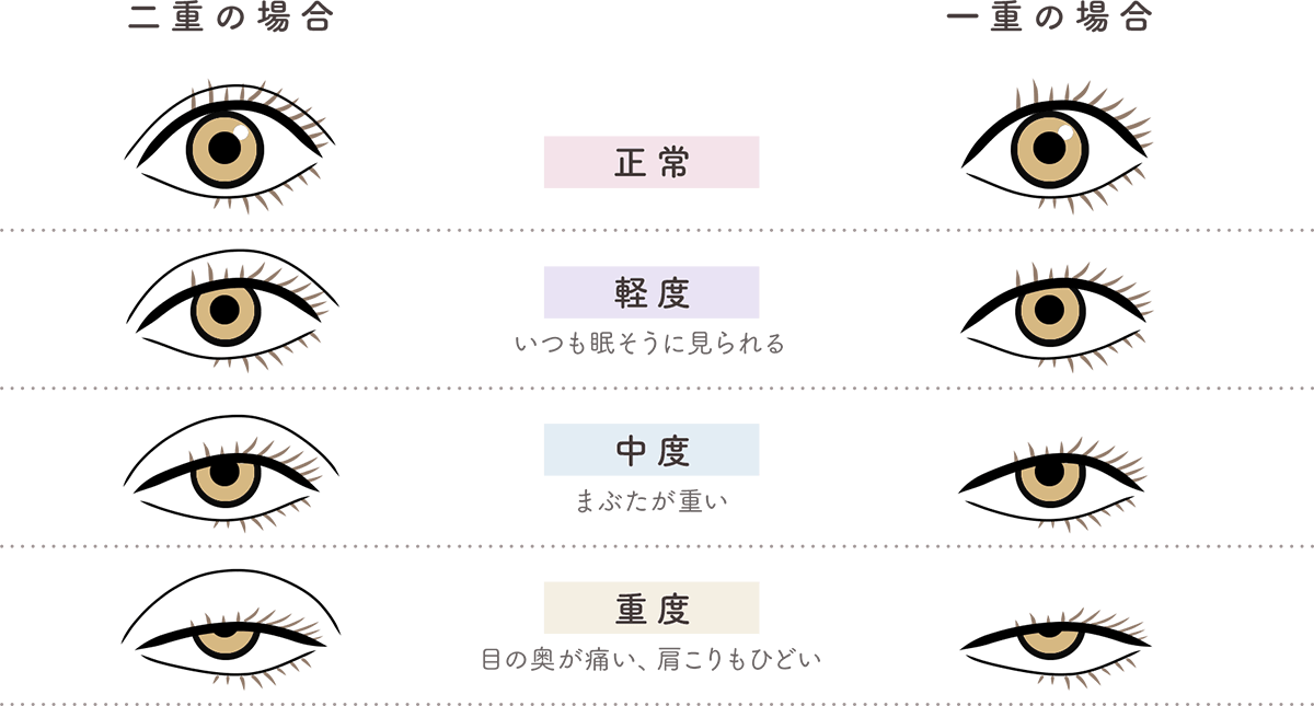 二重の場合 一重の場合 ・正常 ・軽度（いつも眠そうに見られる）・中度（まぶたが重い）・重度（目の奥が痛い、肩こりもひどい）