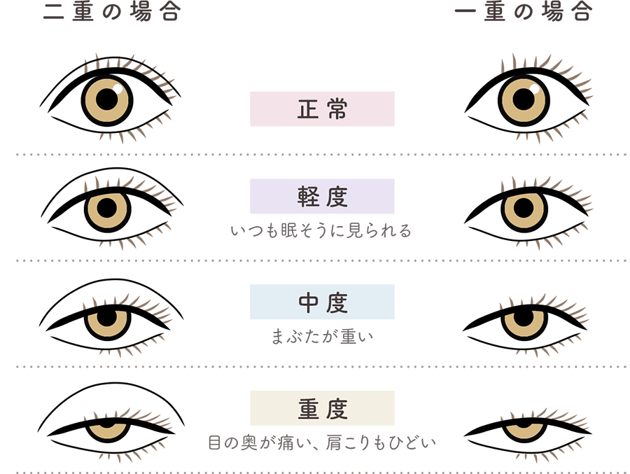 二重の場合 一重の場合 ・正常 ・軽度（いつも眠そうに見られる）・中度（まぶたが重い）・重度（目の奥が痛い、肩こりもひどい）