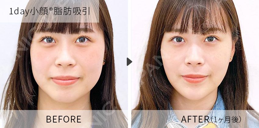 症例写真　1day小顔脂肪吸引