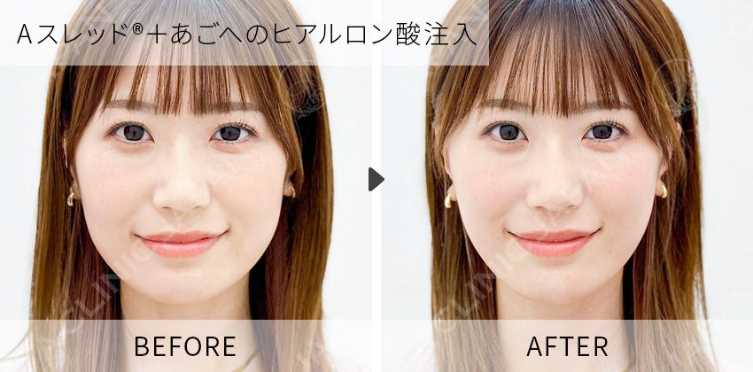 症例写真　Aスレッド+あご形成術（ヒアルロン酸注入）