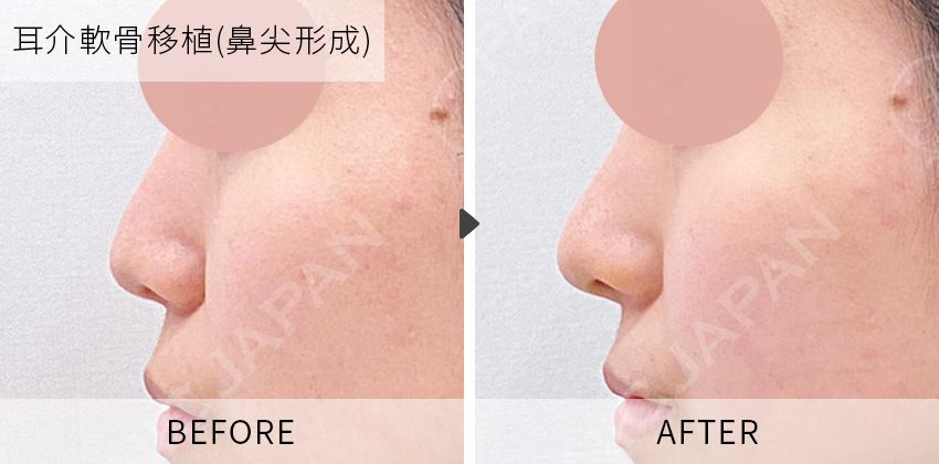 症例写真 耳介軟骨移植(鼻尖形成)