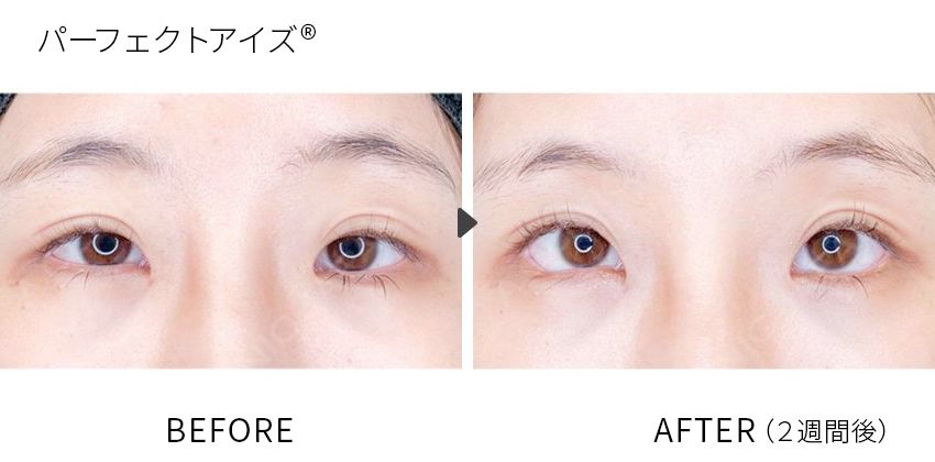 症例写真 パーフェクトアイズ