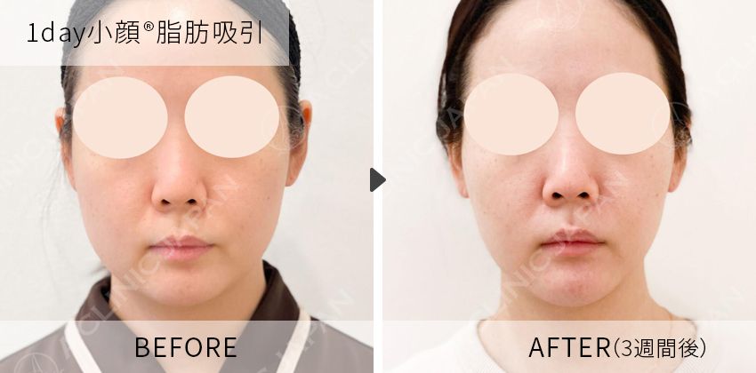 症例写真 1day小顔脂肪吸引