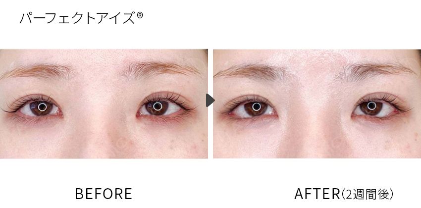 症例写真 パーフェクトアイズ