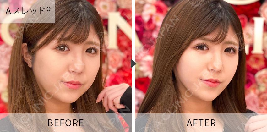 症例写真 Aスレッド