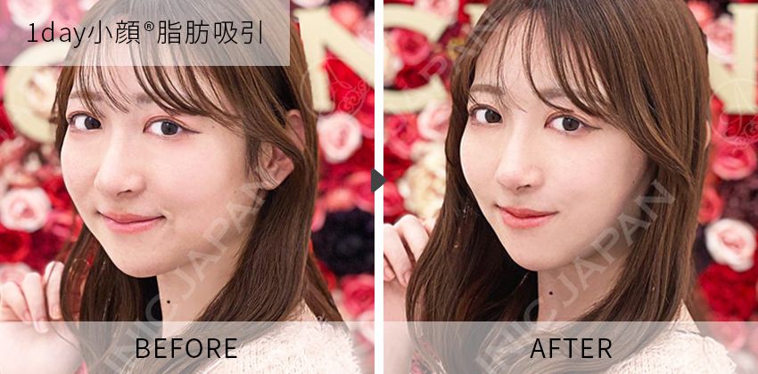 症例写真 1day小顔脂肪吸引