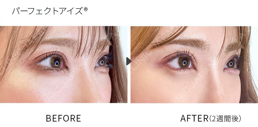症例写真 パーフェクトアイズ
