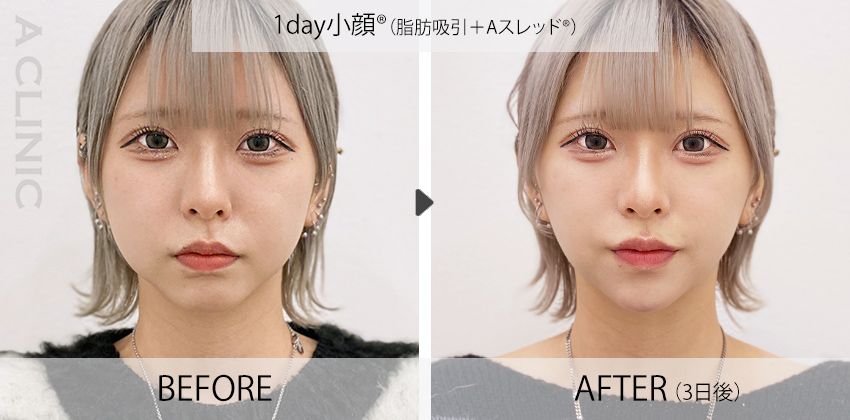 1day小顔