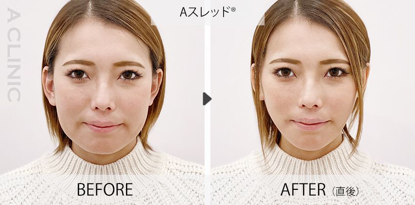 Aスレッド