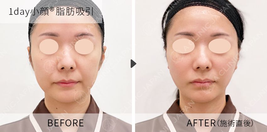 症例写真  1day小顔脂肪吸引