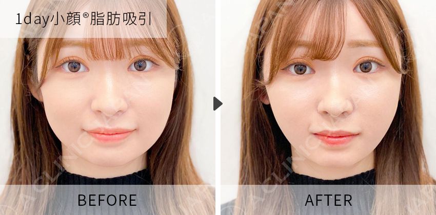 症例写真 1day小顔脂肪吸引
