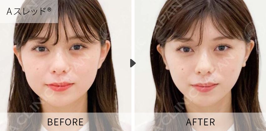 症例写真 Aスレッド