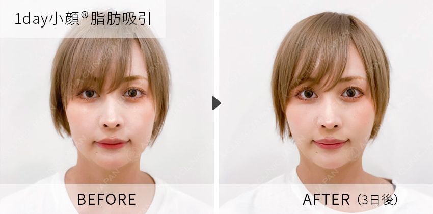 症例写真 パーフェクトアイズ