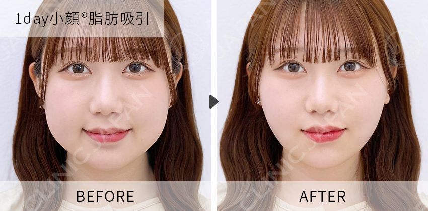 症例写真 1day小顔脂肪吸引