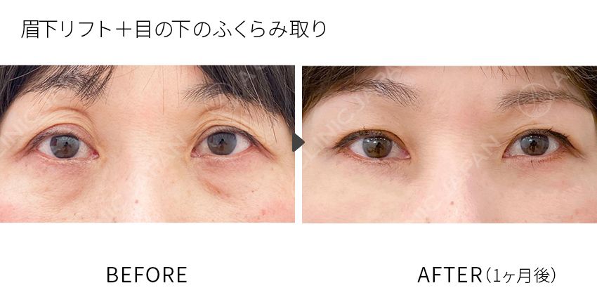 症例写真 眉下リフト+目の下のふくらみ取り