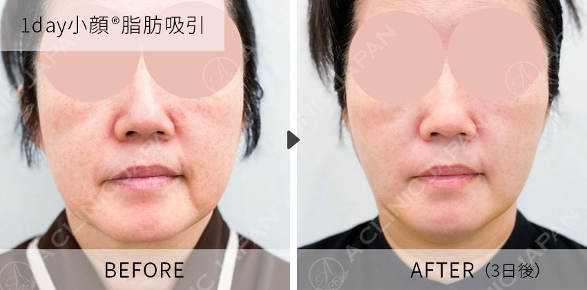 症例写真 1day小顔脂肪吸引