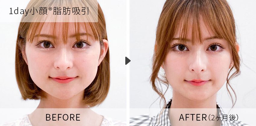 症例写真 1day小顔脂肪吸引