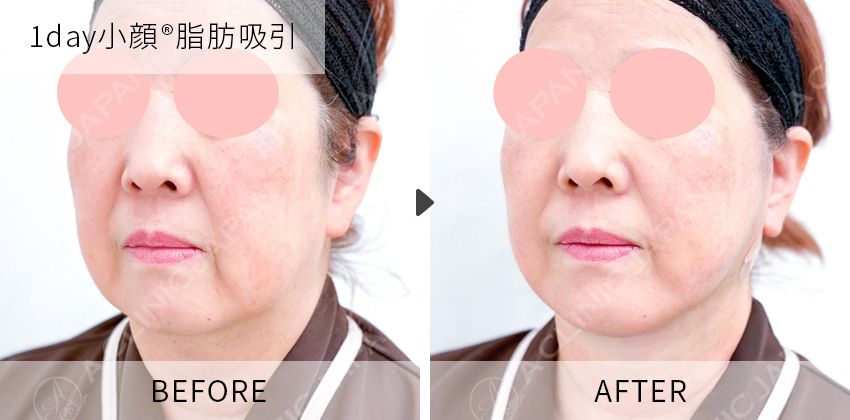症例写真 1day小顔脂肪吸引
