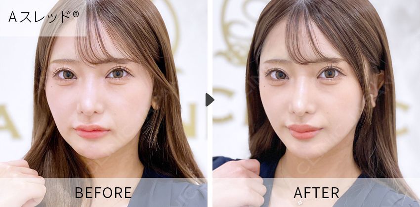 症例写真 Aスレッド®