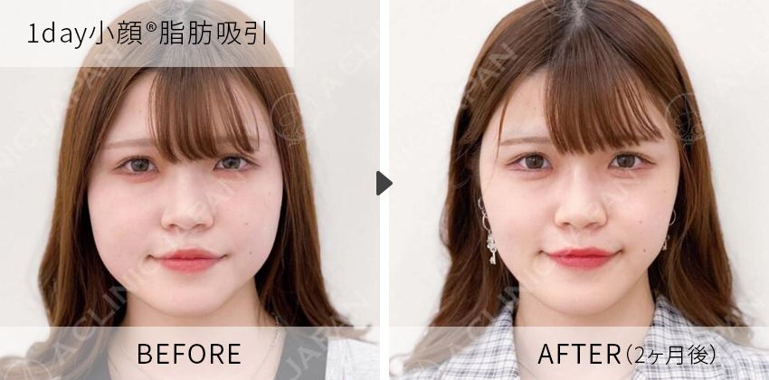 症例写真 1day小顔脂肪吸引