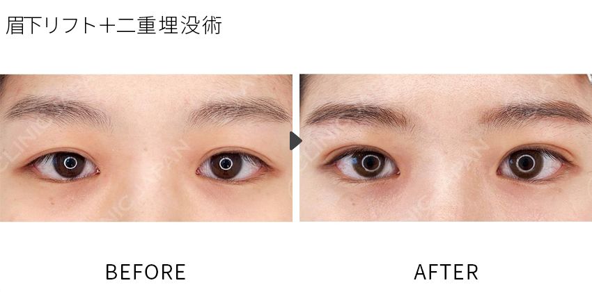 症例写真 眉下リフト(切開法)+二重術埋没法