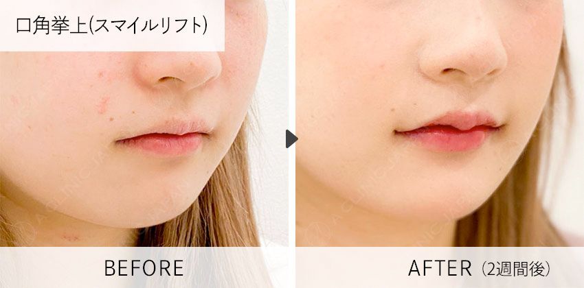 症例写真 口角挙上(スマイルリフト)