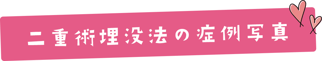 二重術埋没法の症例写真