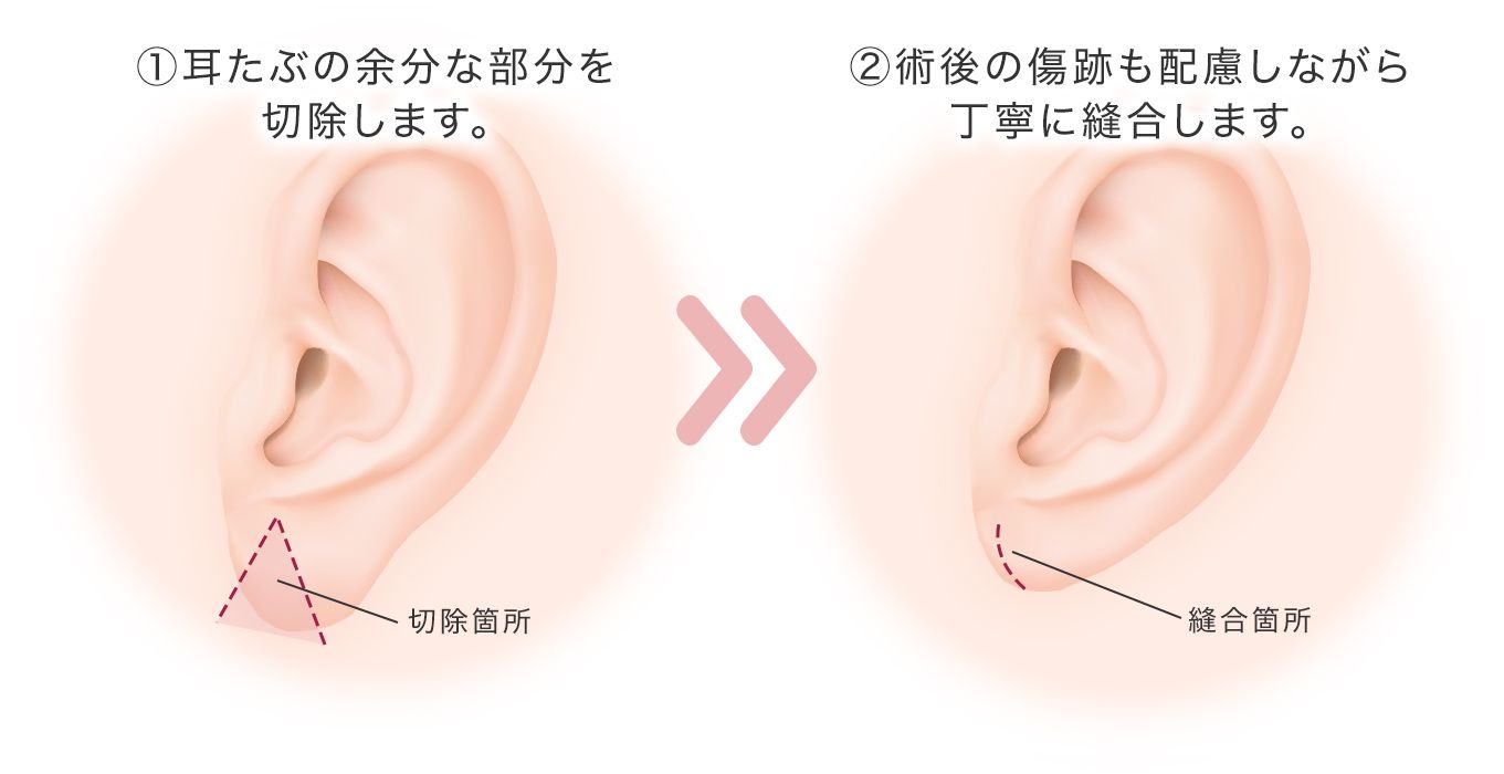 耳たぶ縮小術
