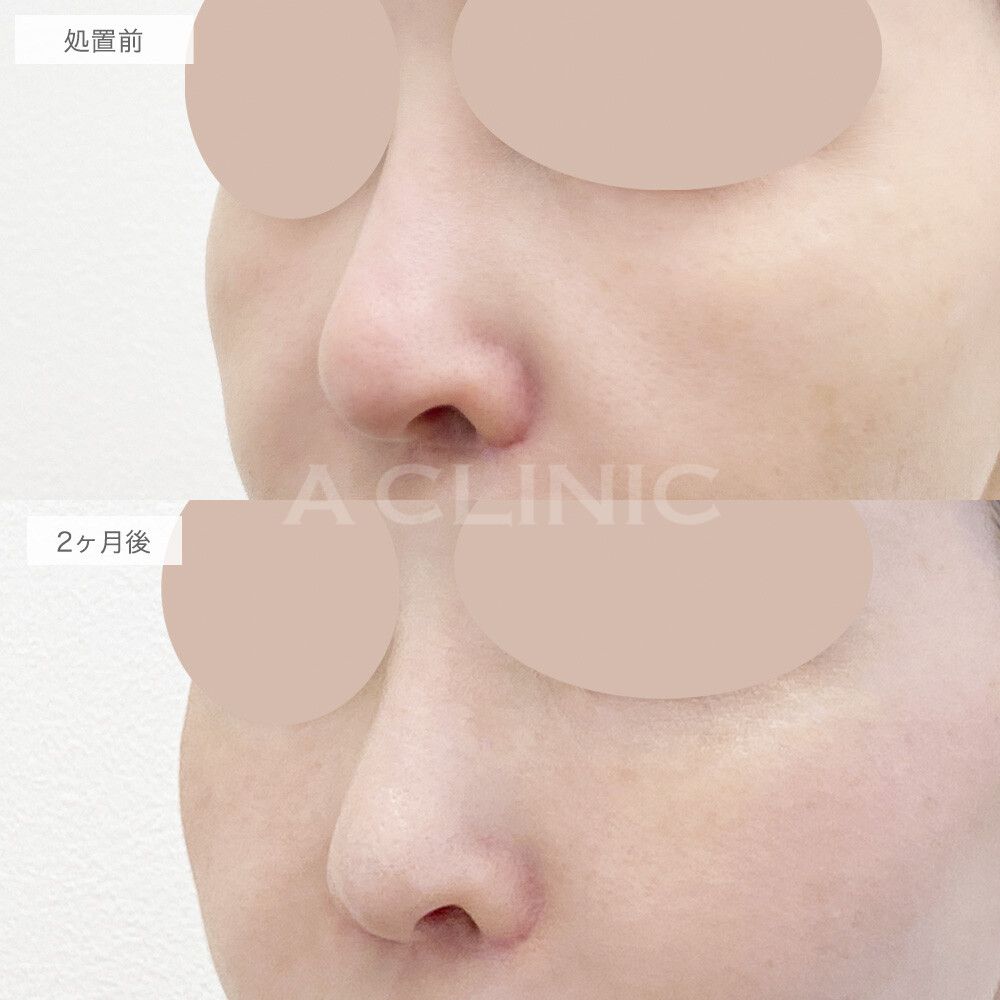 脂肪注入法の症例写真