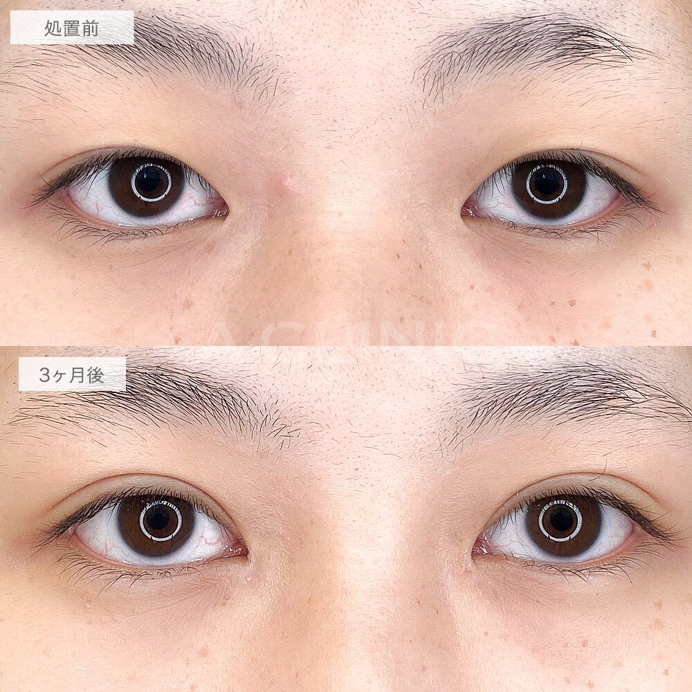 目頭切開症例1