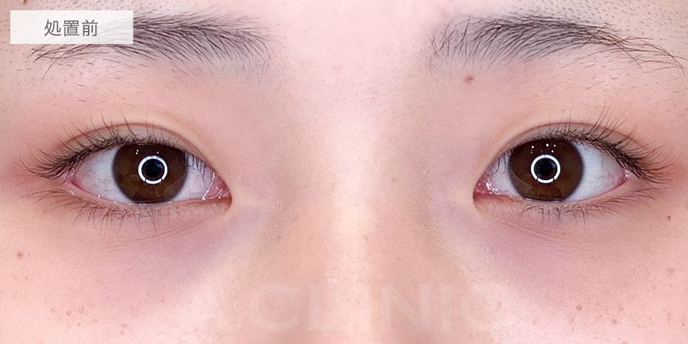 目頭切開症例3