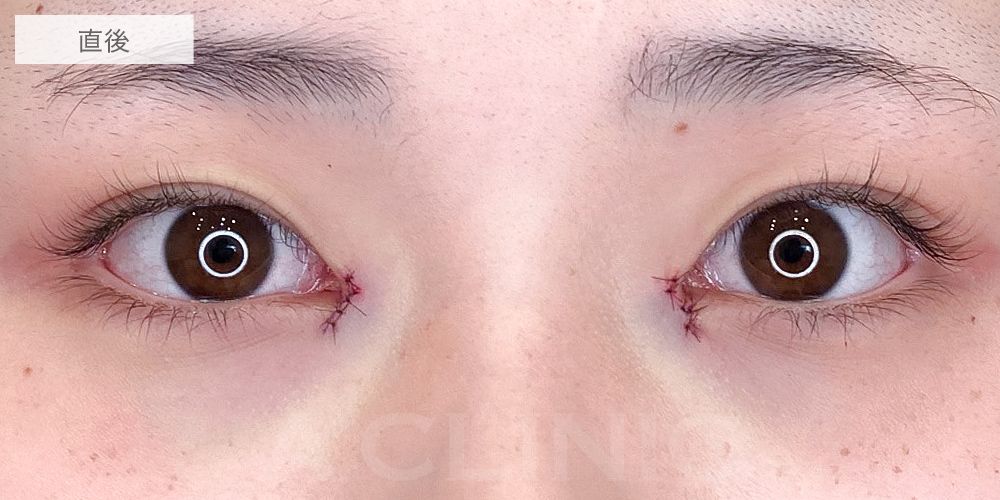 目頭切開症例4