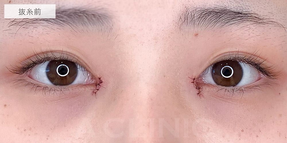 目頭切開症例5