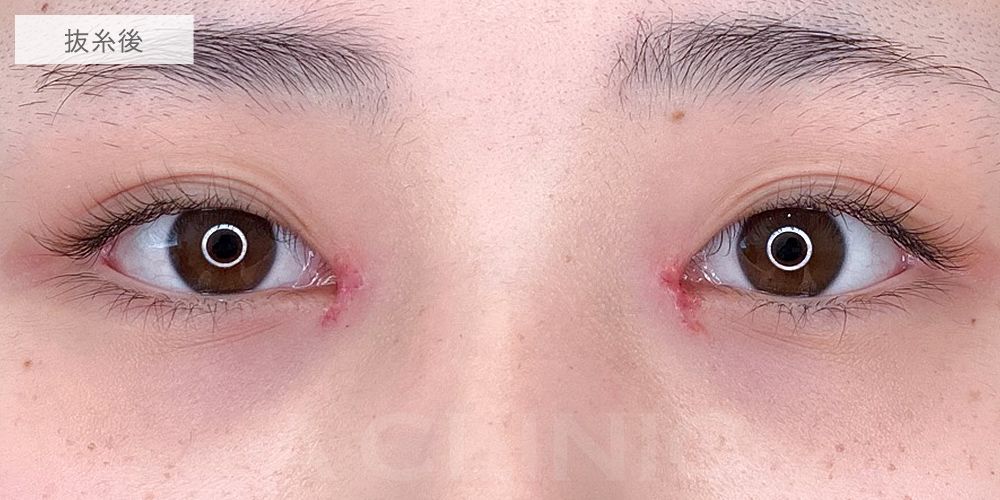 目頭切開症例6