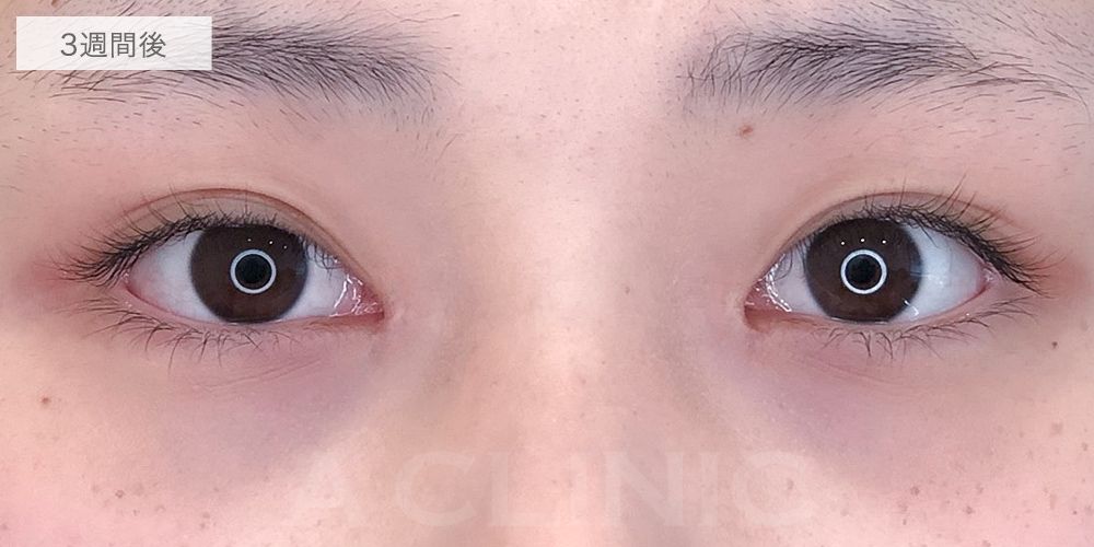 目頭切開症例6