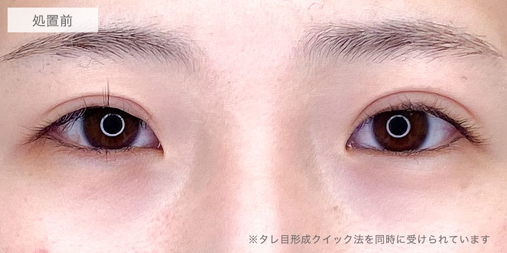 目尻切開症例写真3