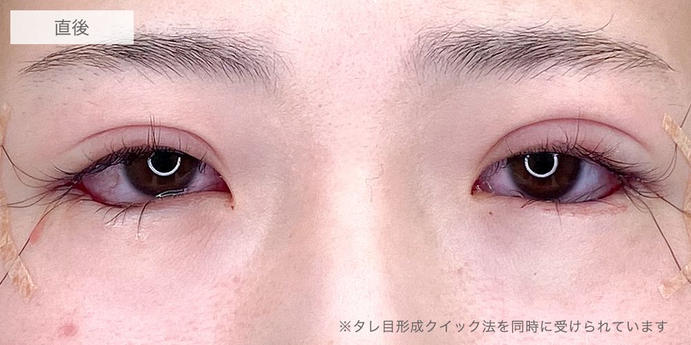目尻切開症例写真4